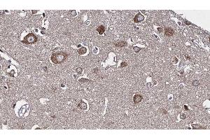 ABIN6277226 at 1/100 staining Human brain cancer tissue by IHC-P.