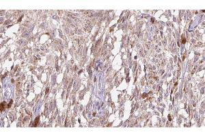 ABIN6276521 at 1/100 staining Human Melanoma tissue by IHC-P. (IL-18 anticorps  (Internal Region))