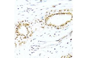 Immunohistochemistry of paraffin-embedded human breast cancer using XRCC4 antibody (ABIN3022381, ABIN3022382, ABIN3022383 and ABIN6218772) at dilution of 1:100 (40x lens).