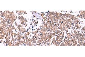 Immunohistochemistry of paraffin-embedded Human lung cancer tissue using IRX2 Polyclonal Antibody at dilution of 1:45(x200) (IRX2 anticorps)