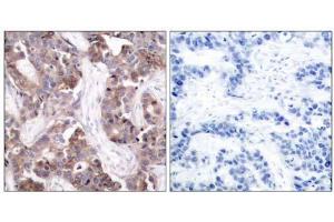Immunohistochemical analysis of paraffin-embedded human breast carcinoma tissue using Stathmin 1 (phospho-Ser24) antibody (E011224). (Stathmin 1 anticorps  (pSer24))