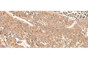 Immunohistochemistry of paraffin-embedded Human liver cancer tissue using LDAH Polyclonal Antibody at dilution of 1:55(x200)