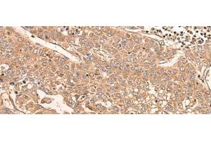 Immunohistochemistry of paraffin-embedded Human liver cancer tissue using LDAH Polyclonal Antibody at dilution of 1:55(x200) (LDAH/C2orf43 anticorps)