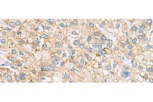 Immunohistochemistry of paraffin-embedded Human liver cancer tissue using HMOX1 Polyclonal Antibody at dilution of 1:70(x200)