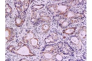 Formalin-fixed and paraffin embedded human colon carcinoma labeled with Anti-Survivin Polyclonal Antibody, Unconjugated (ABIN670911) at 1:200, followed by conjugation to the secondary antibody and DAB staining (Survivin anticorps  (AA 85-142))