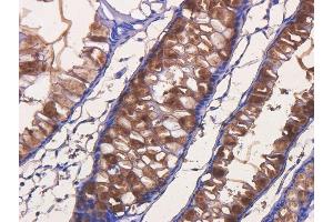 Immunohistochemical staining of human rectal carcinoma using anti-TAG72 antibody  Formalin fixed human rectal carcinoma slices were were stained with  at 5 µg/ml.