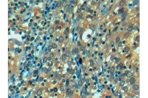 Detection of HSPA1L in Human Endometrial cancer Tissue using Monoclonal Antibody to Heat Shock 70 kDa Protein 1 Like Protein (HSPA1L)