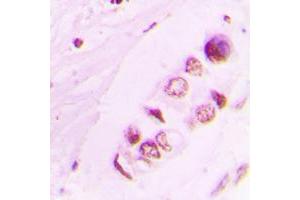 Immunohistochemical analysis of Histone H3 (AcK9) staining in human lung cancer formalin fixed paraffin embedded tissue section.