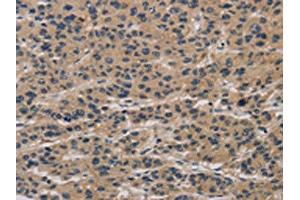 The image on the left is immunohistochemistry of paraffin-embedded Human liver cancer tissue using ABIN7190293(CLEC2A Antibody) at dilution 1/20, on the right is treated with synthetic peptide.