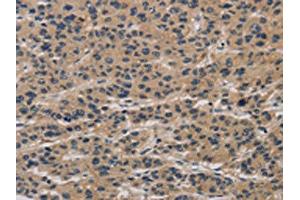 The image on the left is immunohistochemistry of paraffin-embedded Human liver cancer tissue using ABIN7190293(CLEC2A Antibody) at dilution 1/20, on the right is treated with synthetic peptide. (CLEC2A anticorps)