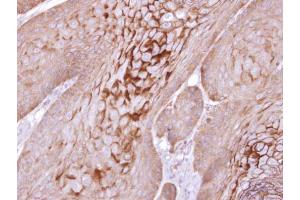 IHC-P Image Immunohistochemical analysis of paraffin-embedded Cal27 xenograft, using KLK11, antibody at 1:100 dilution.