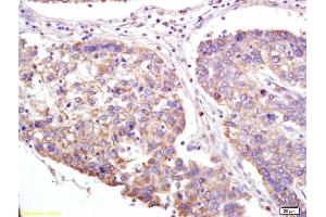 Formalin-fixed and paraffin embedded human lung carcinoma labeled with Anti-XAGE2 Polyclonal Antibody, Unconjugated (ABIN721750) at 1:200 followed by conjugation to the secondary antibody and DAB staining. (XAGE2 anticorps  (AA 30-70))