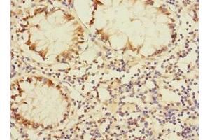 Immunohistochemistry of paraffin-embedded human colon cancer using ABIN7150754 at dilution of 1:100 (DUSP16 anticorps  (AA 416-665))