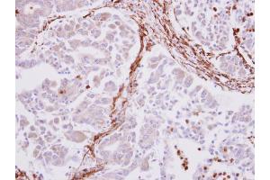 IHC-P Image alpha smooth muscle Actin antibody detects alpha smooth muscle Actin protein at cytoplasm on human liver carcinoma stroma by immunohistochemical analysis.
