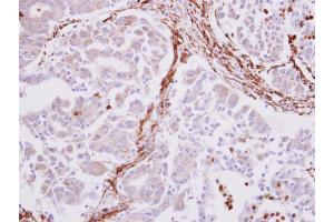 IHC-P Image alpha smooth muscle Actin antibody detects alpha smooth muscle Actin protein at cytoplasm on human liver carcinoma stroma by immunohistochemical analysis. (Smooth Muscle Actin anticorps  (N-Term))