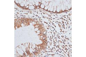 Immunohistochemistry of paraffin-embedded human colon carcinoma using KIFC1 antibody (ABIN1680592, ABIN3017666, ABIN3017667 and ABIN6220203) at dilution of 1:100 (40x lens).