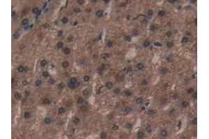 Detection of ACP in Human Liver cancer Tissue using Polyclonal Antibody to Acyl Carrier Protein, Mitochondrial (ACP)