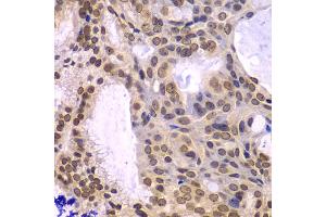 Immunohistochemistry of paraffin-embedded human oophoroma using POLD3 antibody (ABIN5974362) at dilution of 1/100 (40x lens). (POLD3 anticorps)