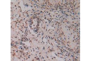 IHC-P analysis of pancreas cancer tissue, with DAB staining. (PAK2 anticorps  (AA 177-419))