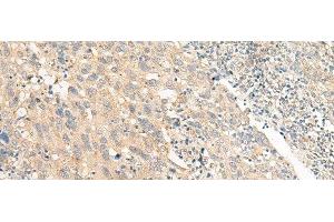 Immunohistochemistry of paraffin-embedded Human cervical cancer tissue using CHP1 Polyclonal Antibody at dilution of 1:25(x200) (CHP anticorps)