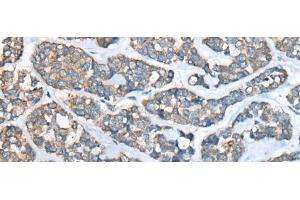 Immunohistochemistry of paraffin-embedded Human esophagus cancer tissue using GULP1 Polyclonal Antibody at dilution of 1:65(x200) (GULP1 anticorps)