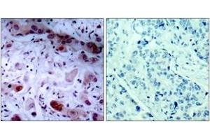 Immunohistochemistry analysis of paraffin-embedded human breast carcinoma, using JAK1 (Phospho-Tyr1022) Antibody. (JAK1 anticorps  (pTyr1022))