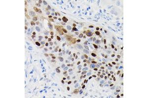 Immunohistochemistry of paraffin-embedded human esophageal cancer using [KO Validated] Cyclin D1 Rabbit mAb (ABIN7266561) at dilution of 1:100 (40x lens).