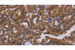 Immunohistochemistry of paraffin-embedded Human thyroid cancer tissue using NPTX1 Polyclonal Antibody at dilution 1:50 (NPX1 anticorps)