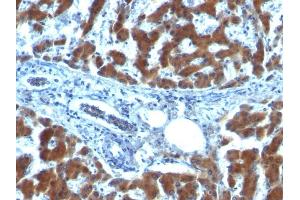 Formalin-fixed, paraffin-embedded human Hepatocellular Carcinoma stained with RBP1 (RBP/872)