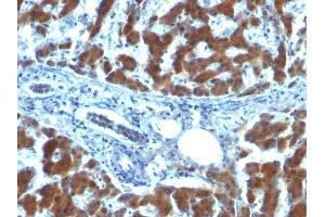 Formalin-fixed, paraffin-embedded human Hepatocellular Carcinoma stained with RBP1 (RBP/872) (RBP1 anticorps)