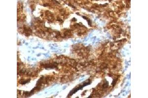IHC testing of human prostate carcinoma with TAG-72 antibody (CA72/733). (TAG-72 anticorps)