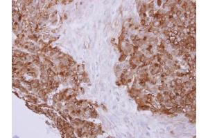 IHC-P Image Profilin 2 antibody detects PFN2 protein at cytoplasm on human colon carcinoma by immunohistochemical analysis. (PFN2 anticorps)