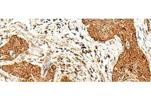 Immunohistochemistry of paraffin-embedded Human esophagus cancer tissue using SMOC1 Polyclonal Antibody at dilution of 1:50(x200) (SMOC1 anticorps)