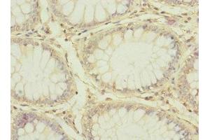 Immunohistochemistry of paraffin-embedded human colon cancer using ABIN7147204 at dilution of 1:100 (CD97 anticorps  (AA 240-435))