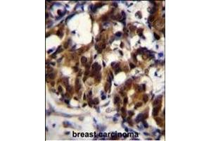 TRADD Antibody (Center) (ABIN655903 and ABIN2845303) immunohistochemistry analysis in formalin fixed and paraffin embedded human breast carcinoma followed by peroxidase conjugation of the secondary antibody and DAB staining.