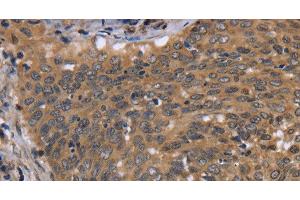 Immunohistochemistry of paraffin-embedded Human cervical cancer using FGFR1OP Polyclonal Antibody at dilution of 1:40 (FGFR1OP anticorps)