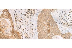 Immunohistochemistry of paraffin-embedded Human esophagus cancer tissue using PAX5 Polyclonal Antibody at dilution of 1:30(x200) (PAX5 anticorps)