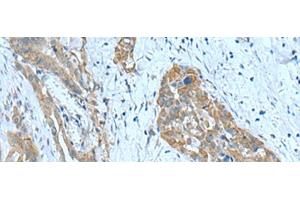 Immunohistochemistry of paraffin-embedded Human thyroid cancer tissue using SRPK2 Polyclonal Antibody at dilution of 1:90(x200) (SRPK2 anticorps)