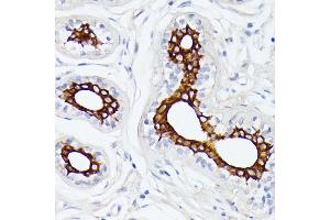 Immunohistochemistry of paraffin-embedded human breast cancer using MT-ND5 antibody (ABIN7268603) at dilution of 1:100 (40x lens). (MT-ND5 anticorps  (C-Term))