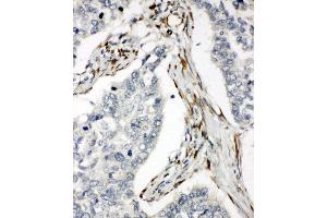 Anti-DR5 antibody, IHC(P) IHC(P): Human Lung Cancer Tissue