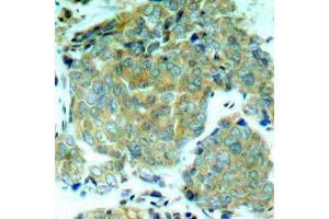 Immunohistochemistry of paraffin-embedded human breast carcinoma using Phospho-eIF2α-S51 antibody (ABIN2987989). (EIF2S1 anticorps  (pSer51))