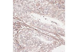 Immunohistochemistry of paraffin-embedded human uterine cancer using L antibody (ABIN7268186) at dilution of 1:100 (40x lens). (Laminin gamma 1 anticorps  (AA 1300-1609))