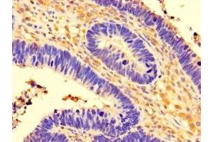 Immunohistochemistry of paraffin-embedded human ovarian cancer using ABIN7148172 at dilution of 1:100