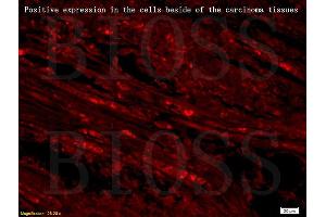 Formalin-fixed and paraffin embedded human gastric carcinoma labeled with Anti SLC25A10 Polyclonal Antibody, Unconjugated (ABIN752293) followed by conjugation to the secondary antibody