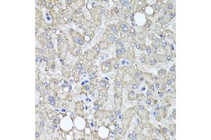 Immunohistochemistry of paraffin-embedded human liver injury using MUC16 antibody (ABIN6003713) at dilution of 1/100 (40x lens). (MUC16 anticorps)