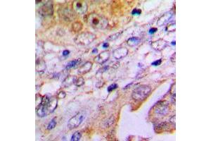 Immunohistochemical analysis of MP68 staining in human lung cancer formalin fixed paraffin embedded tissue section. (C14orf2 anticorps  (Center))