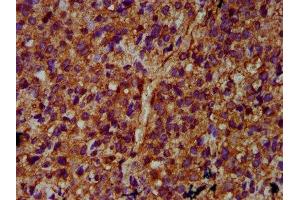IHC image of ABIN7169209 diluted at 1:400 and staining in paraffin-embedded human glioma performed on a Leica BondTM system. (ULK2 anticorps  (AA 211-276))