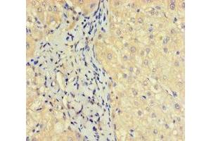 Immunohistochemistry of paraffin-embedded human liver cancer using ABIN7162135 at dilution of 1:100