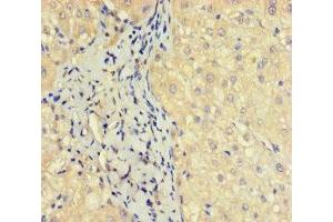 Immunohistochemistry of paraffin-embedded human liver cancer using ABIN7162135 at dilution of 1:100 (OBP2A anticorps  (AA 16-170))