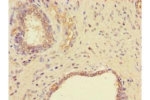 Immunohistochemistry of paraffin-embedded human prostate cancer using ABIN7145523 at dilution of 1:100 (Nerve Growth Factor anticorps  (AA 122-218))